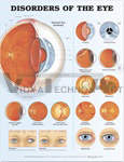 Disorders of the Eye Anatomical Chart, 2nd Edition